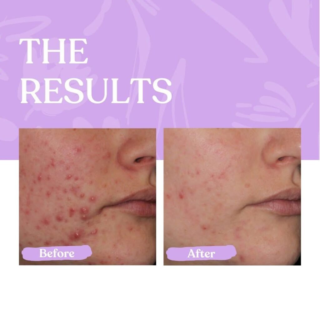 best-acne-treatment-options