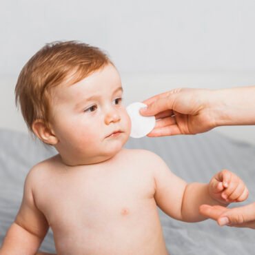 baby acne treatment