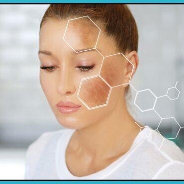best melasma treatment