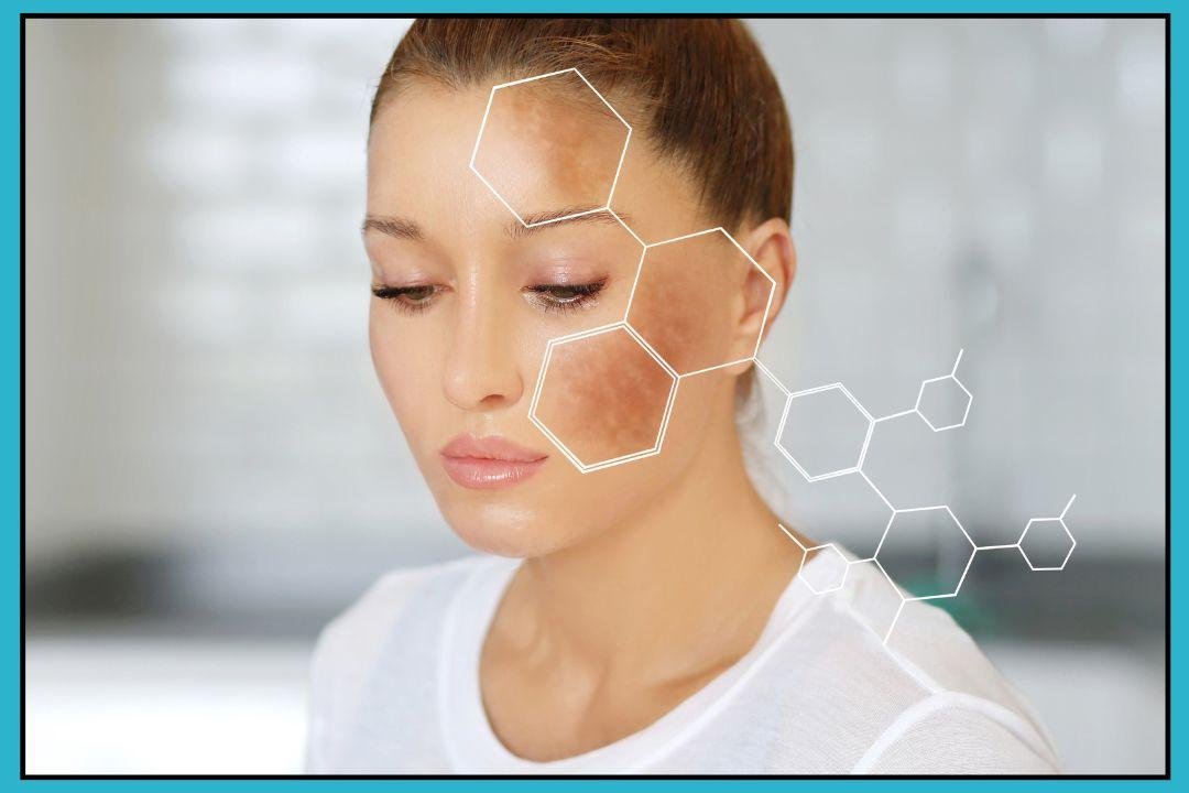 best melasma treatment