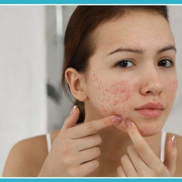 stubborn acne