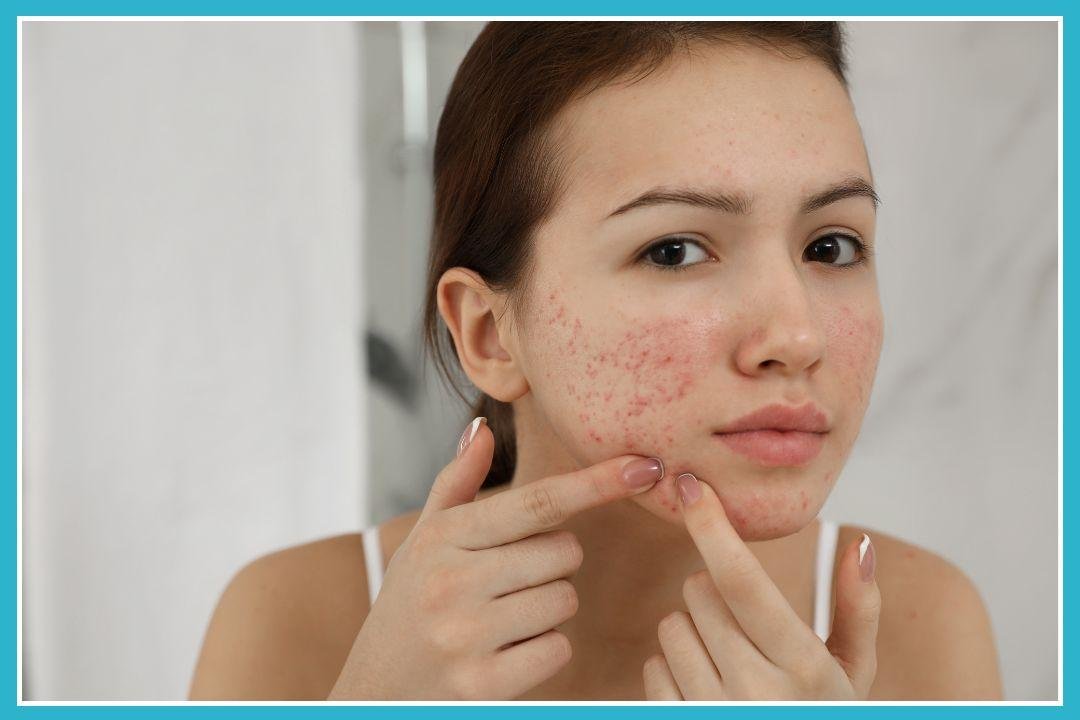 stubborn acne