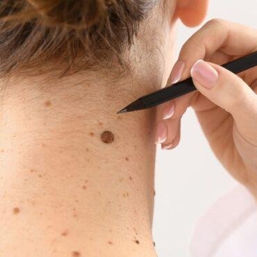 when to get moles checked