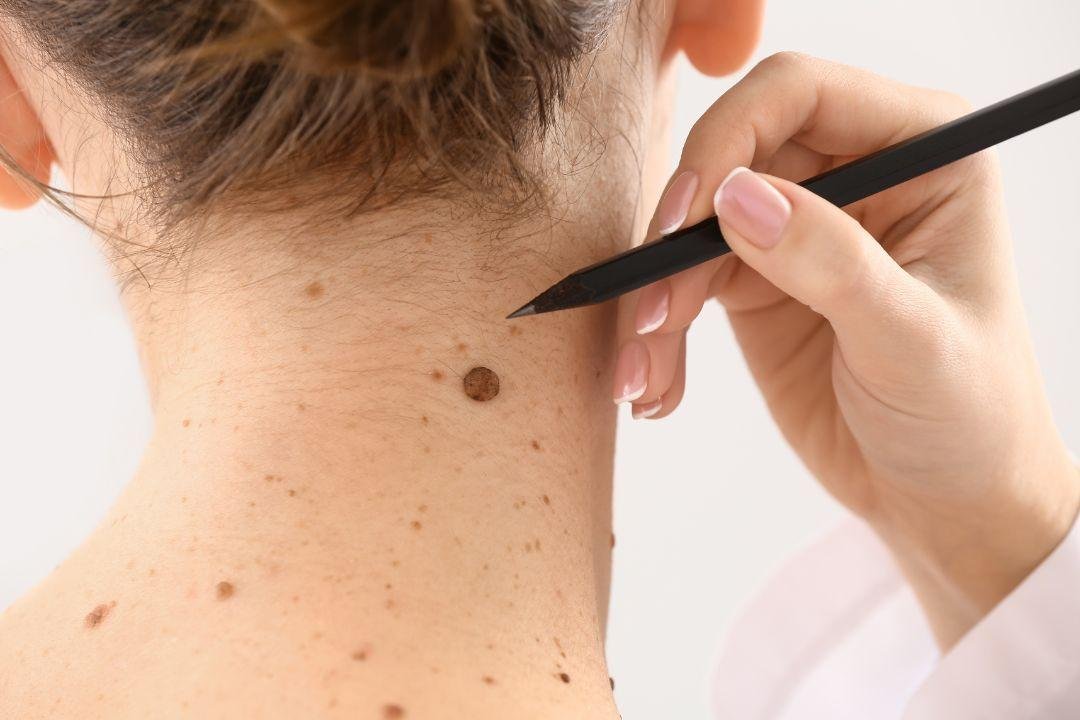 when to get moles checked